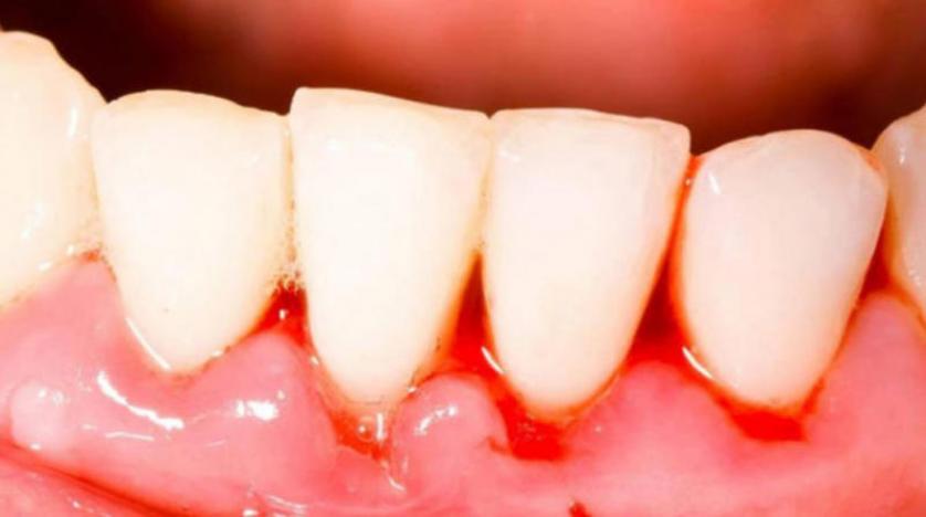 أمراض اللثة الحادة ترتبط بخطر الإصابة