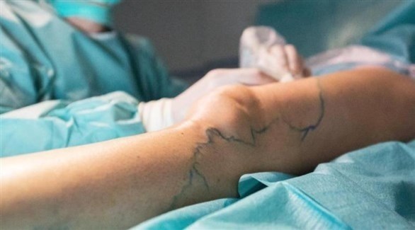 متى ينبغي استئصال دوالي الساقين؟