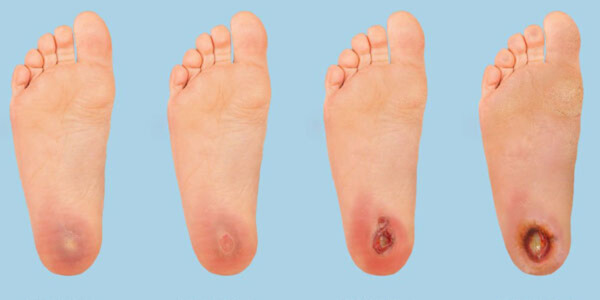 علاج بالخلايا الجذعية يمنع بتر الأطراف