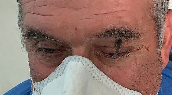 ينغرس مسمار في حاجبه بسبب خطأ