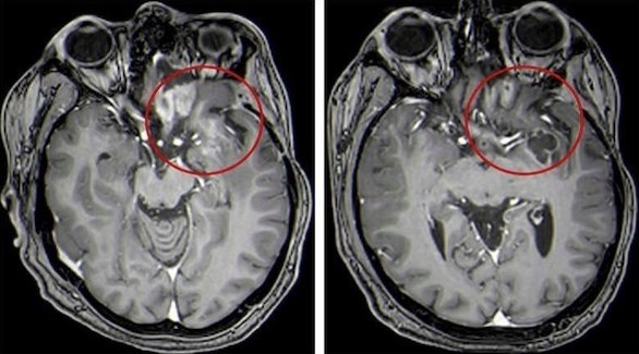 علاج واعد لأورام الدماغ لدى الأطفال