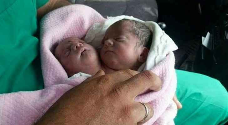 حالة طبية نادرة في إدلب بسوريا..