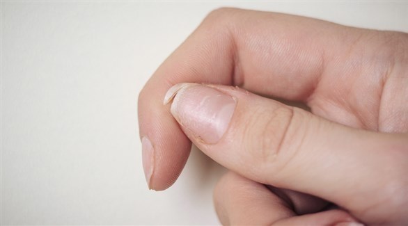 أسباب تقصف الأظافر .. تعرفي عليها