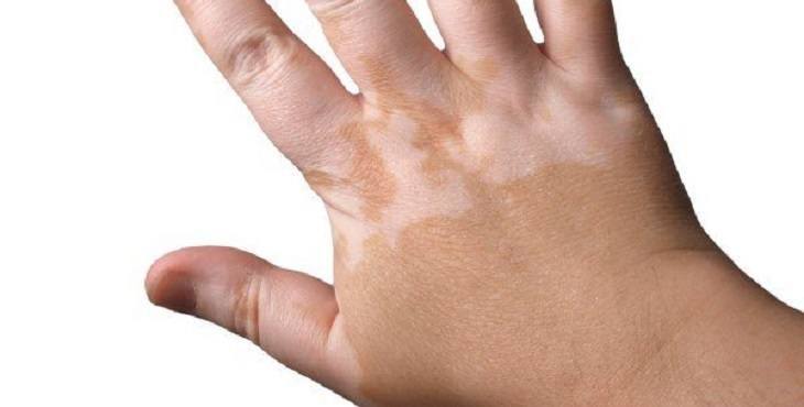 علاجات تخفف من أعراض البهاق في