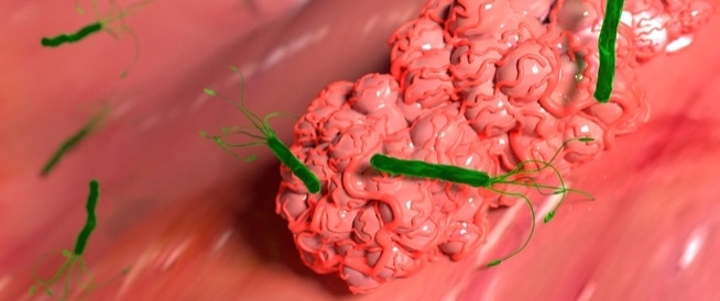 تكتشف ورما بحجم كرة القدم في