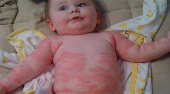 أمل جديد لعلاج حساسية الفول السوداني