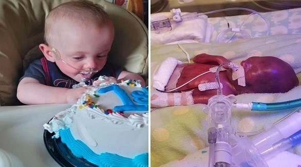 طفل معجزة ولد قبل الأوان بـ