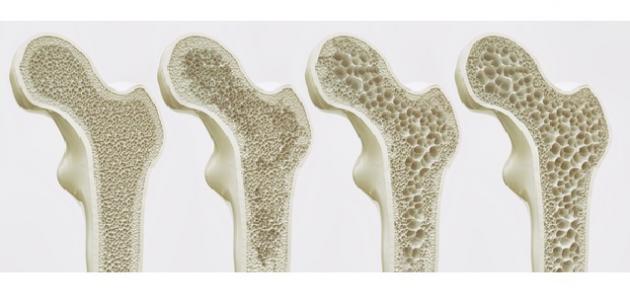 هشاشة العظام تهاجم المرأة في هذه