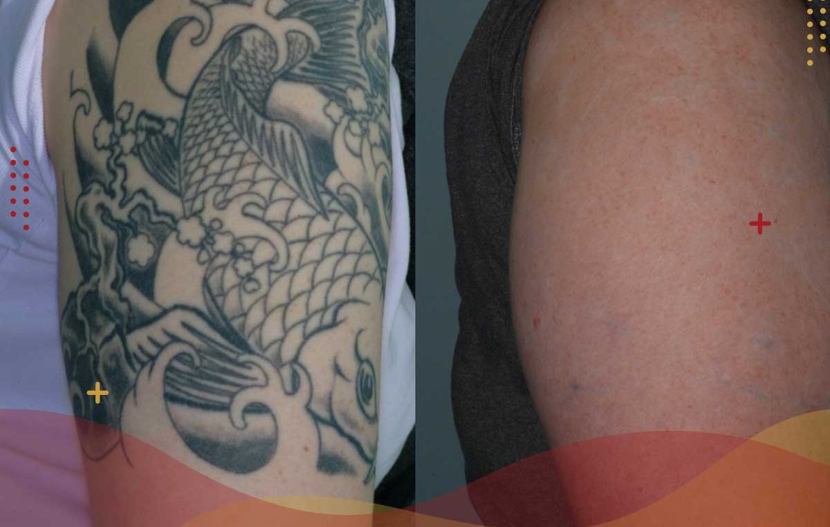أفضل طريقة لإزالة الوشم