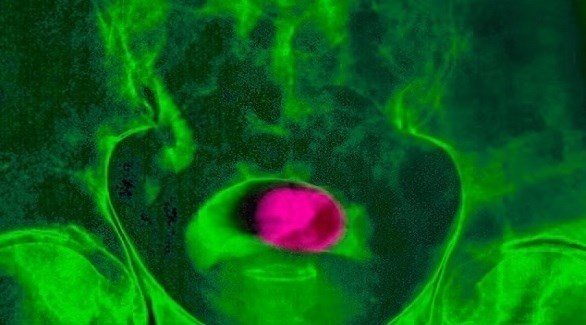 علاج إشعاعي عالي السرعة دواء لمرضى