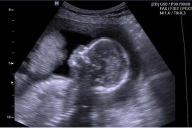 تضحي بساقها لإنقاذ جنينها