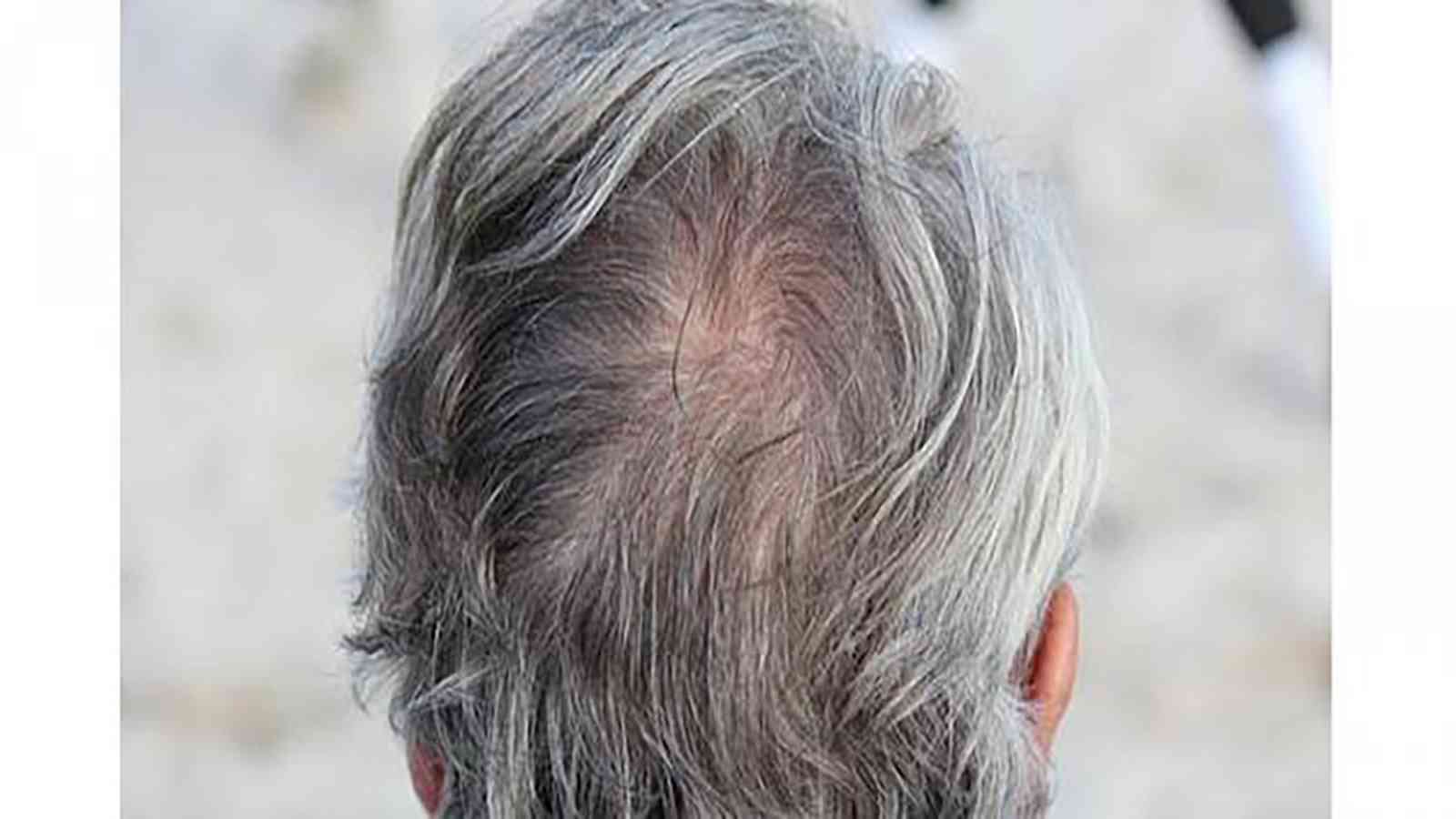 كيف نتجنب الشيب المبكر؟.. وما علاقة