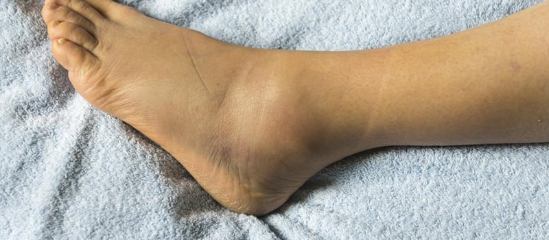 أسباب تورم الأقدام.. . لا علاقة