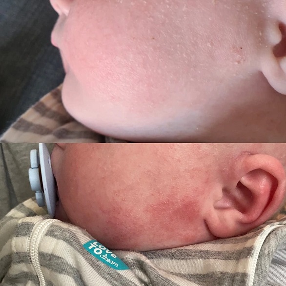 تعالج أكزيما طفلها بكريم مرطب سحري