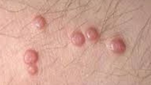 هكذا تحاربين البثور أثناء الدورة الشهرية