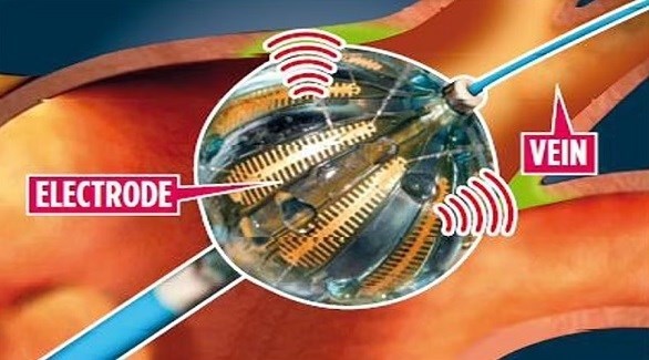 بالون كهربائي بحجم حبة العنب ينظم