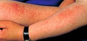 الشمس تضرّ بشرة المرأة