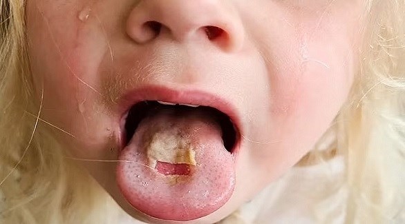 طفلة تصاب بحروق شديدة في فمها