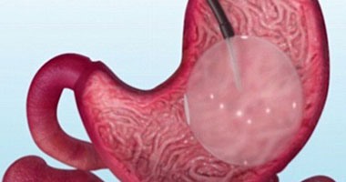 جانب إيجابي للعدوى المعوية