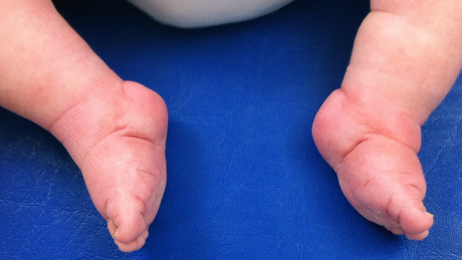 تشوهات أقدام الأطفال.. متى تستلزم استشارة