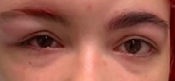 تعاني من حروق كيماوية في الوجه