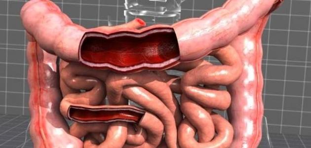 الحمية المناسبة لمرضى القولون العصبي