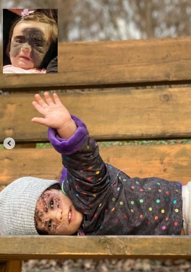 إزالة وحمة “قناع باتمان” من وجه