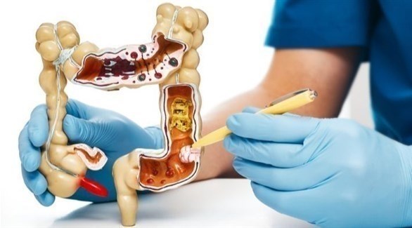 هذه أعراض الإصابة بالتهاب القولون التقرحي