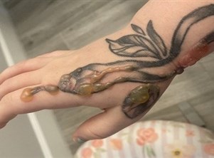 تصاب بحالة صحية غريبة بسبب وشم