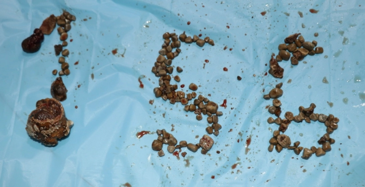 استخراج 156 حصوة من كلية هندي