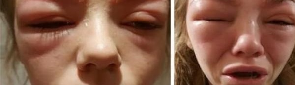 تكاد تفقد بصرها بسبب صبغ حاجبيها