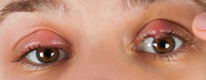 علامات شعيرة العين المؤلمة وطرق علاجها