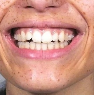 شرب الماء بعد الوجبات يساعد على