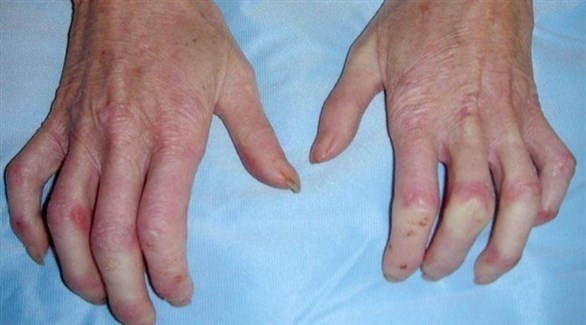 تصلب الجلد.. يهدد بأمراض خطيرة