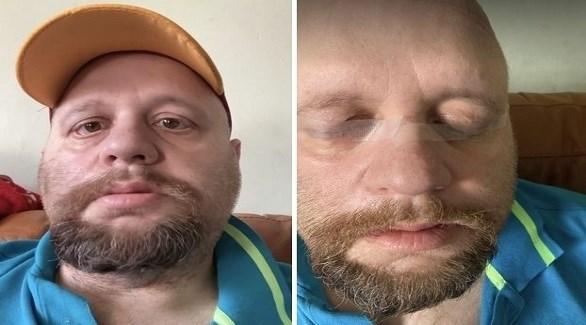 يضطر لإغلاق عينيه بشريط لاصق بسبب