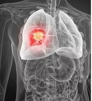 أعراض شائعة للسرطان يتجاهلها الكثيرون