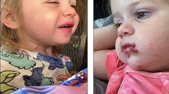 طفلة تعاني من التهابات شديدة حول