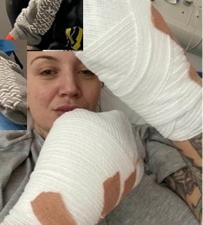 تخضع لبتر جميع أصابع يديها جراء