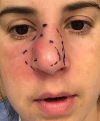 تزيل أنفها بالكامل بسبب آلامها المبرحة