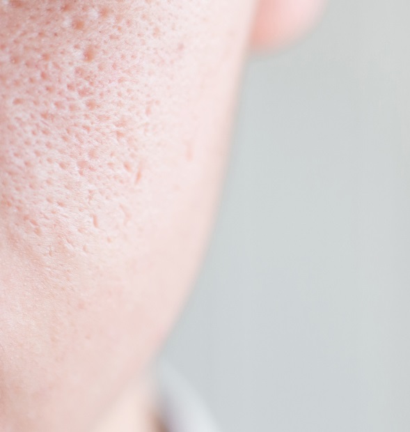 لماذا تظهر مسام الوجه الواسعة وكيف