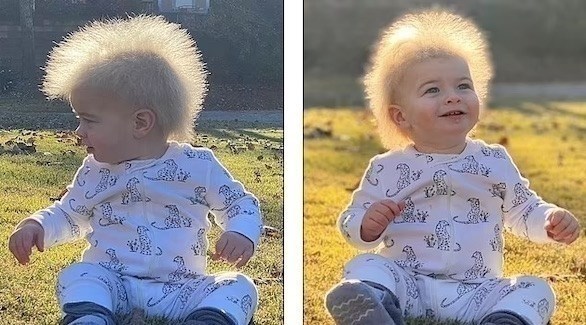 طفل يعاني حالة نادرة جدا تجعل