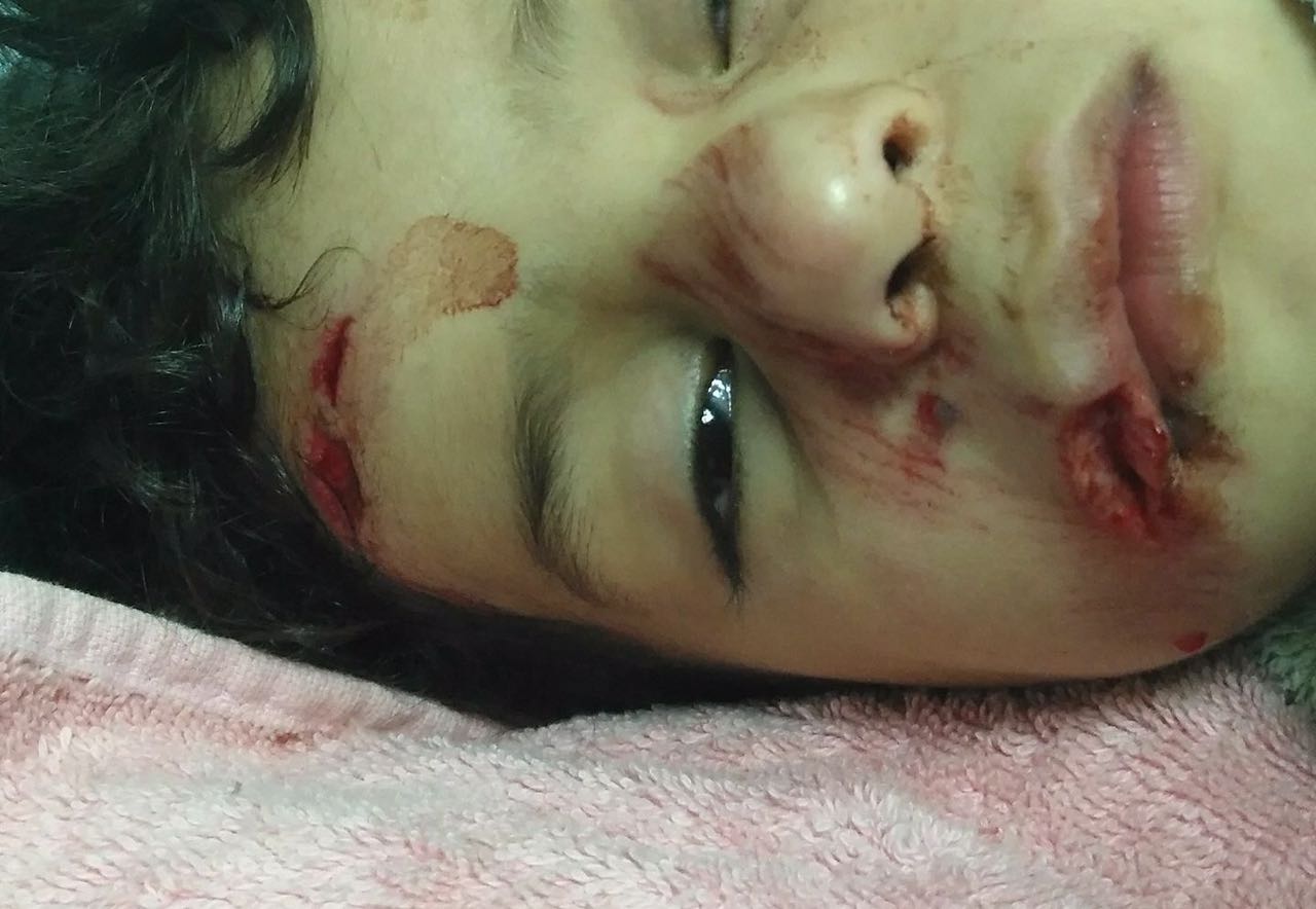 خيط تقطيب الجروح غير متوافر في