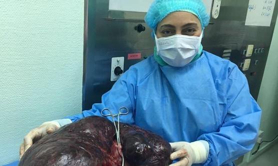 إزالة ورم يزن 17.5 كيلوغراما من