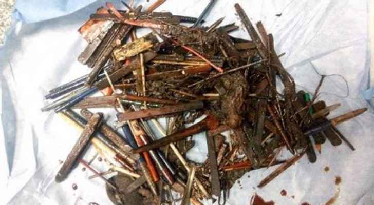 إخراج مئات المسامير من بطن مريض