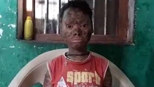 فتاة تبدل جلدها كل 6 أسابيع