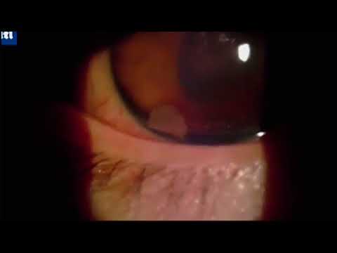 شاهد.. مخلوق يستوطن عين فتى ويحير