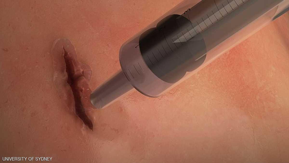 غراء طبي يغلق الجروح خلال 60