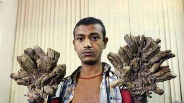 16 عملية جراحية تعيد “الرجل الشجرة”