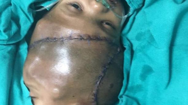 جراحة تفصل توأمين ملتصقين من الرأس