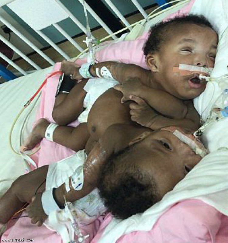 السعودية.. نجاح فصل التوأم السوداني جود